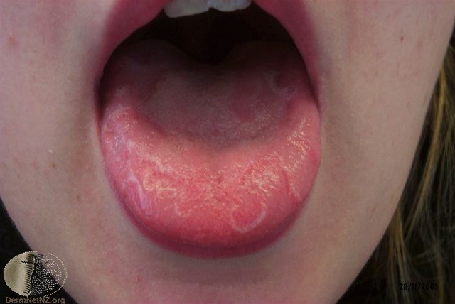 symptomer-geografisk tunge lingua geographica jpg