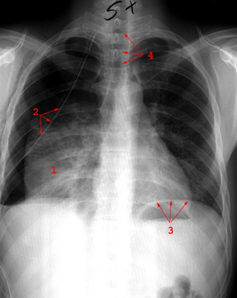 lunger-lobaerpneumoni-roentgen