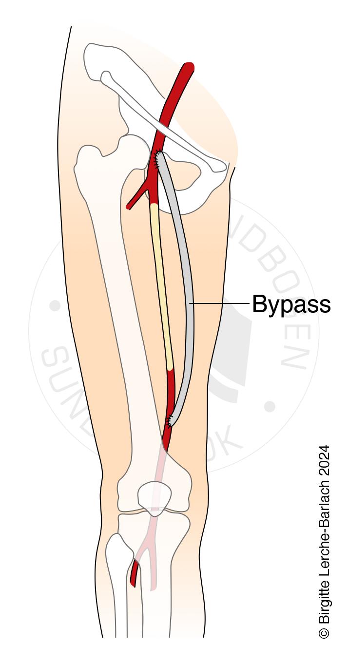 LH_Ateriel bypass ben_Ny