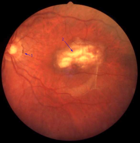 oejne-senil makuladegenerasjon