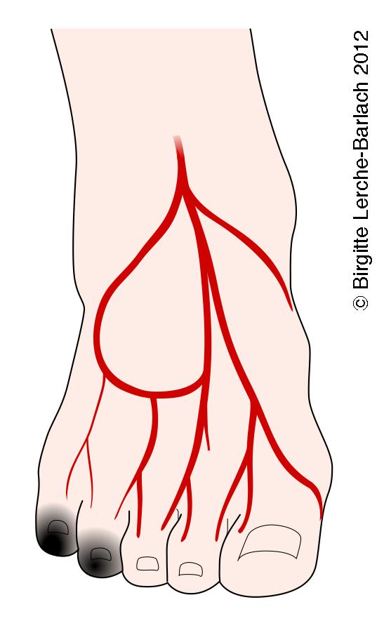 aarer-Burgers sygdom