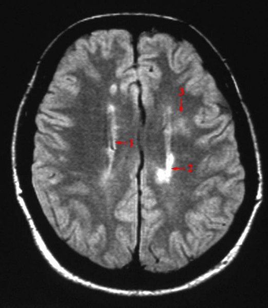 hjerne-ms forandringer demyelinisering 2-mr