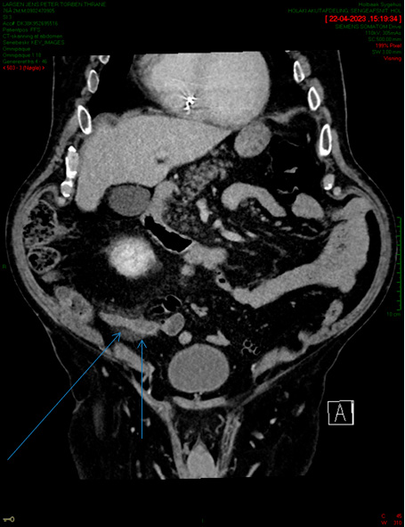 acute appendicitis