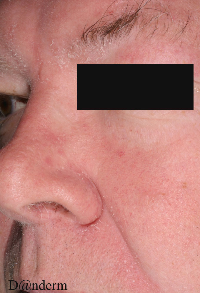 seboroisk eksem - pande Danderm