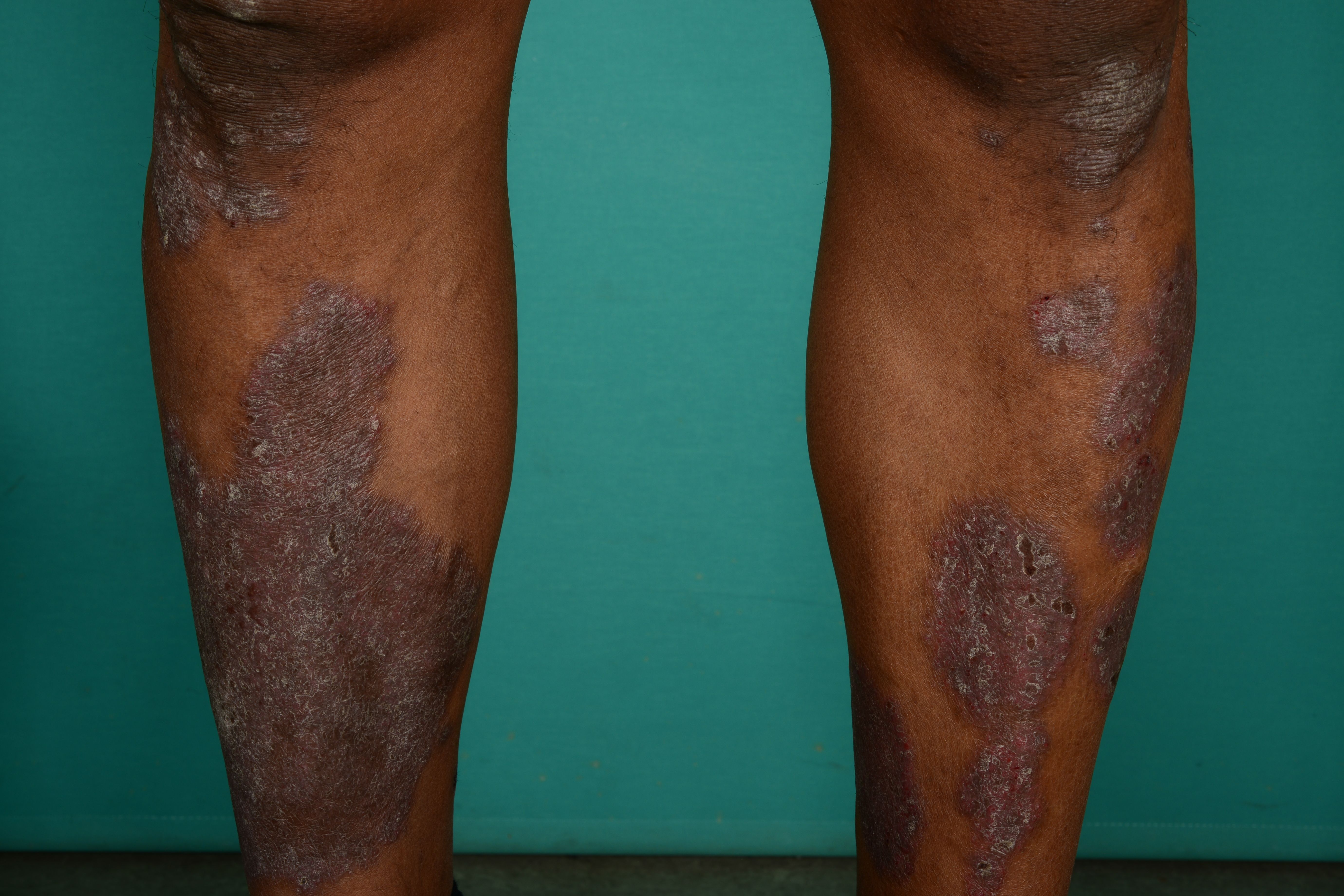 Neurodermatit underben 50429