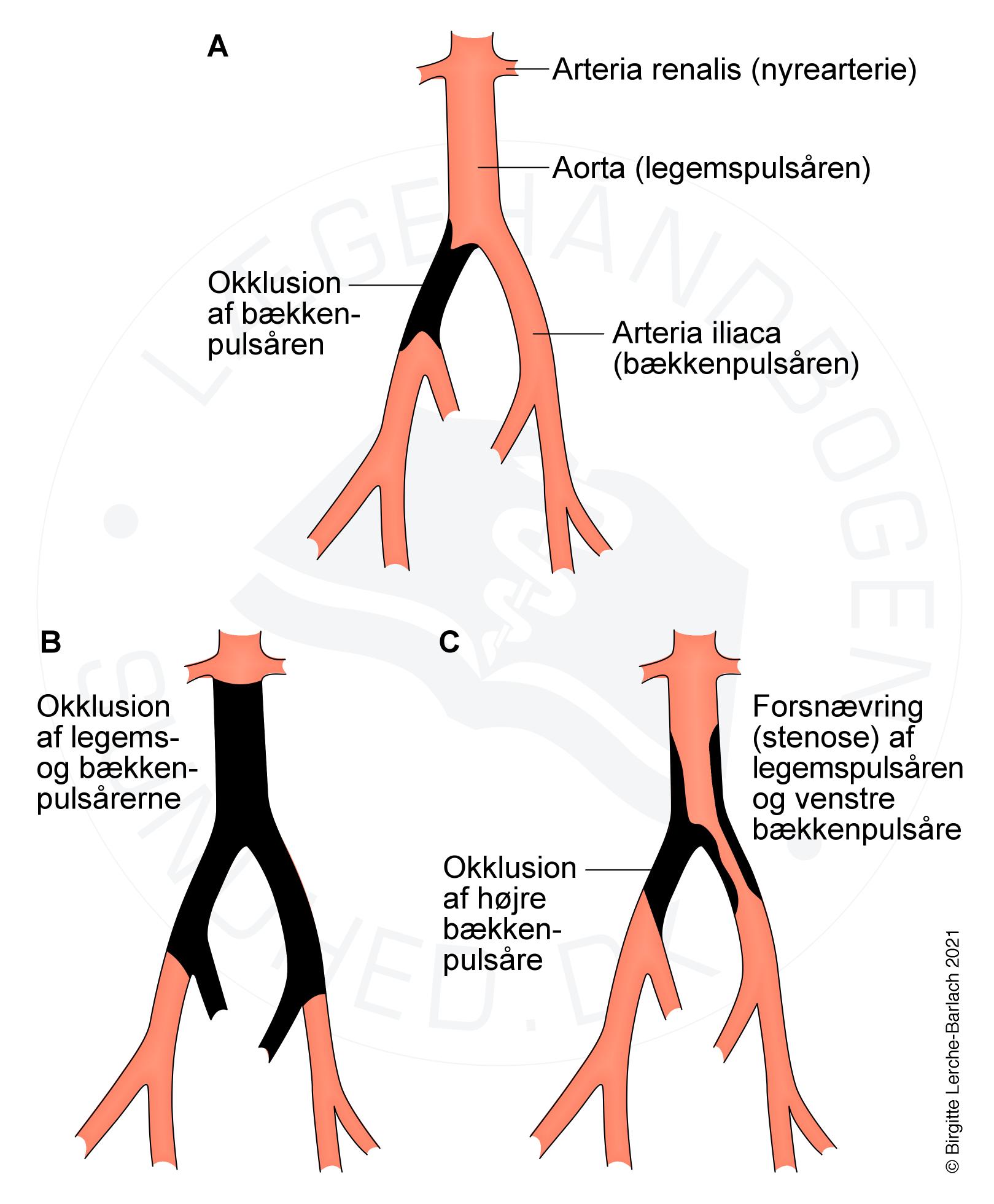 arterier-trombotiske tilstande