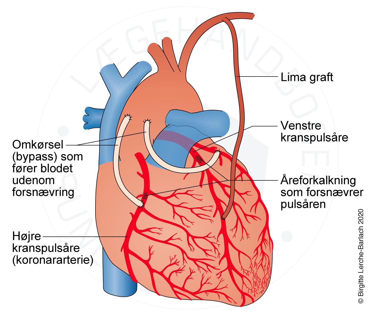 10117 2 Koronar bypass jpg jpg