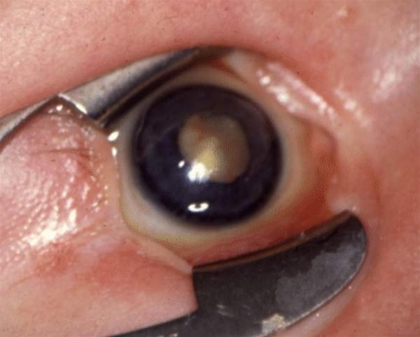 foto der viser retinoblastom.