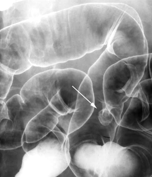 colon-polyp-roentgen
