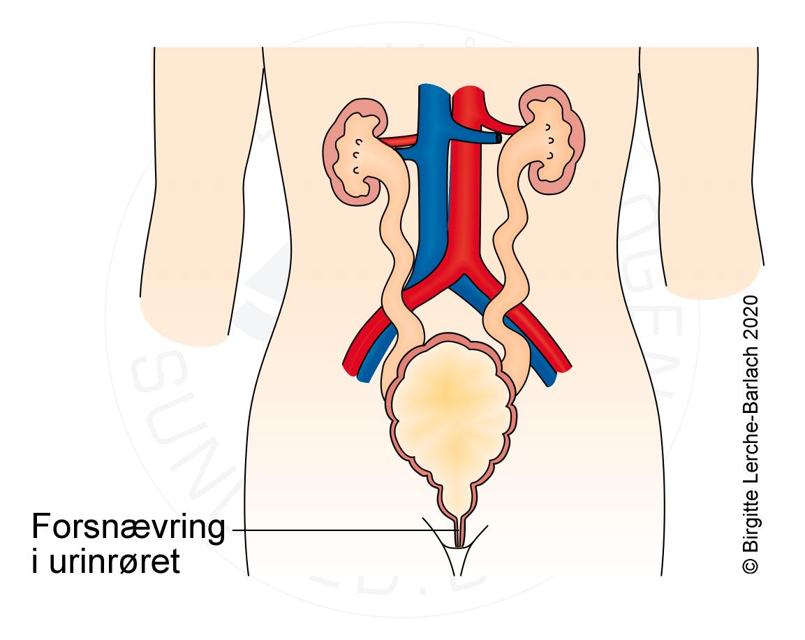 LH_Urethraklap miktionscystournethografi