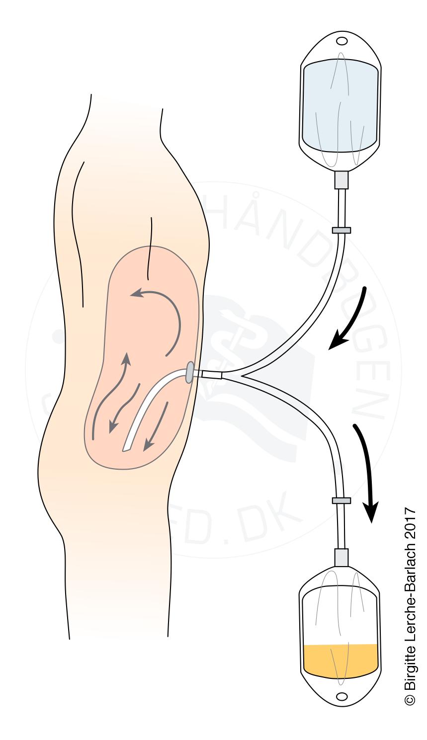 nyrer-peritonaldialyse skema