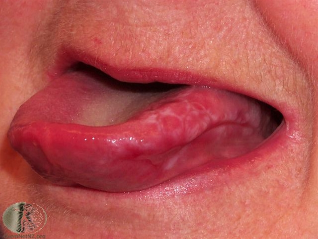 oral lichen planus-yderside tunge