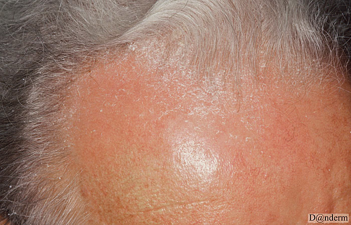 seboroisk eksem - isse - Danderm