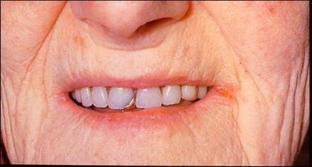 mund-mundvigsfissurer hos patient med jernmangel