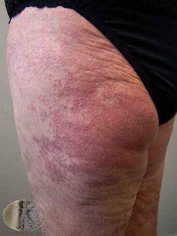 granuloma annulare udbredt-laar