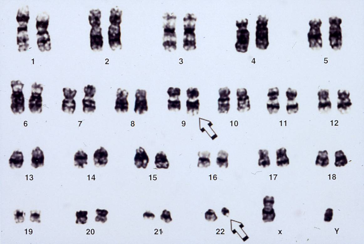 blod-philadelphia kromosomet