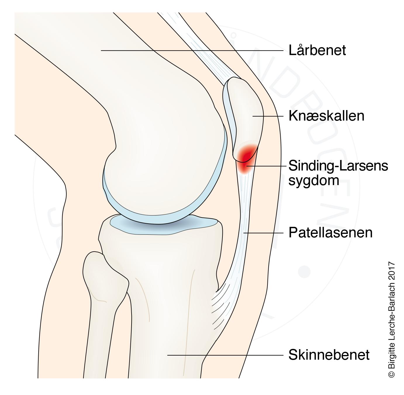 LH_2736 Sinding-Larsens syg
