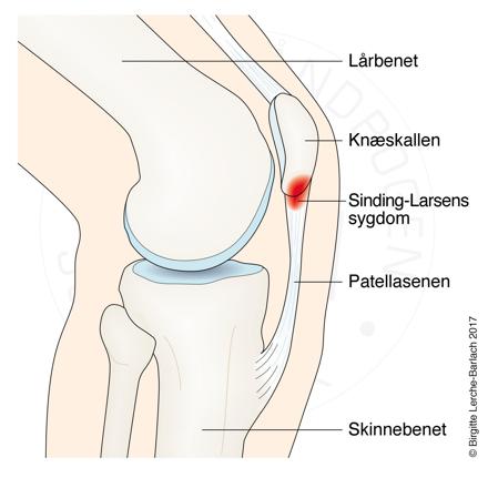 Sinding-Larsen, knæ.