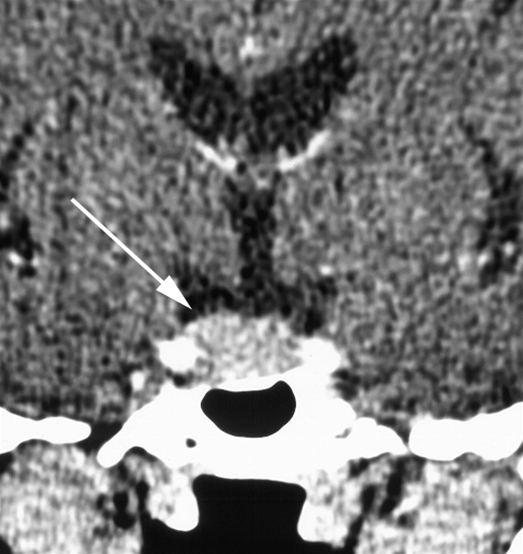 hjerne-hypofysetumor-ct