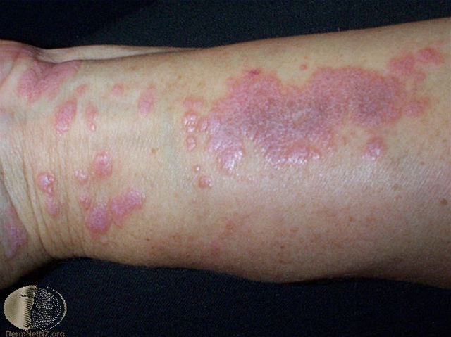 lichen planus whickhams stria