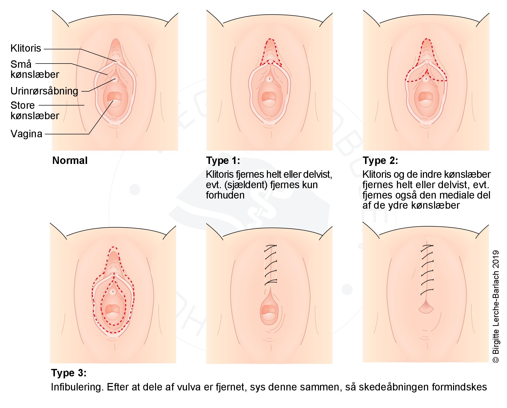 kvindelig-omskaering