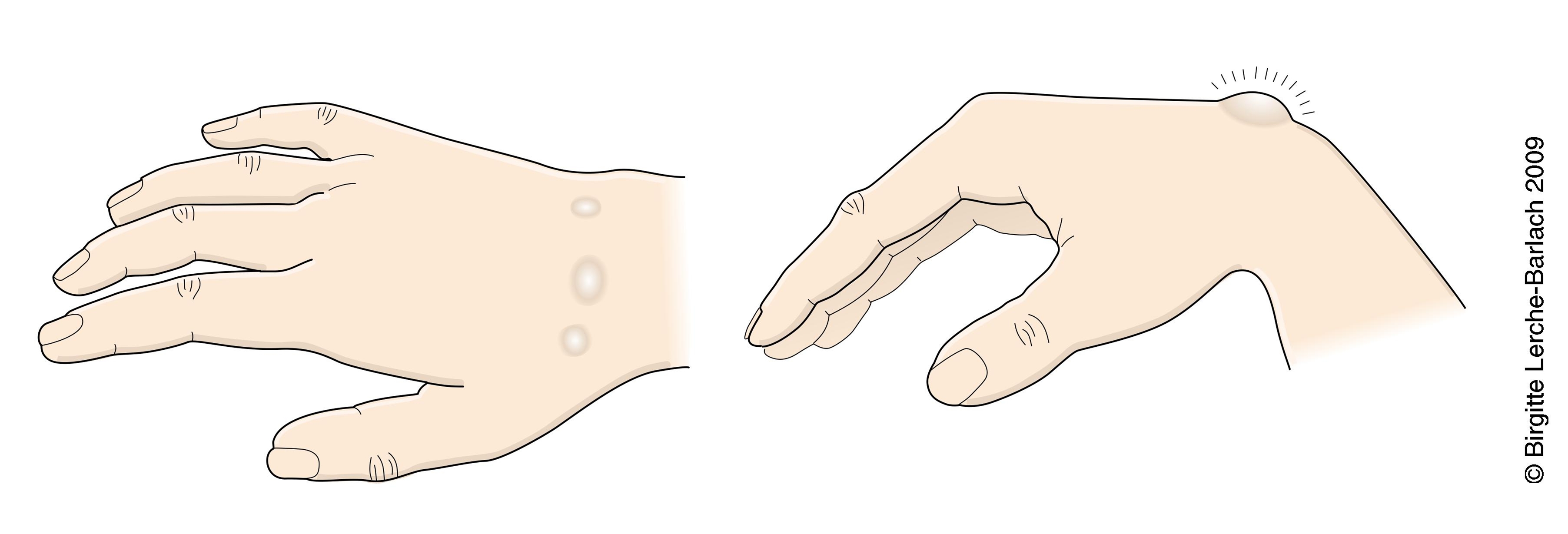 haand-ganglier paa dorsalleddets forside