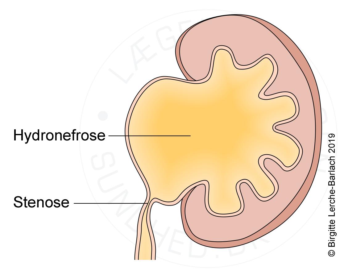 Ureteropelvin striktur urografi (1)