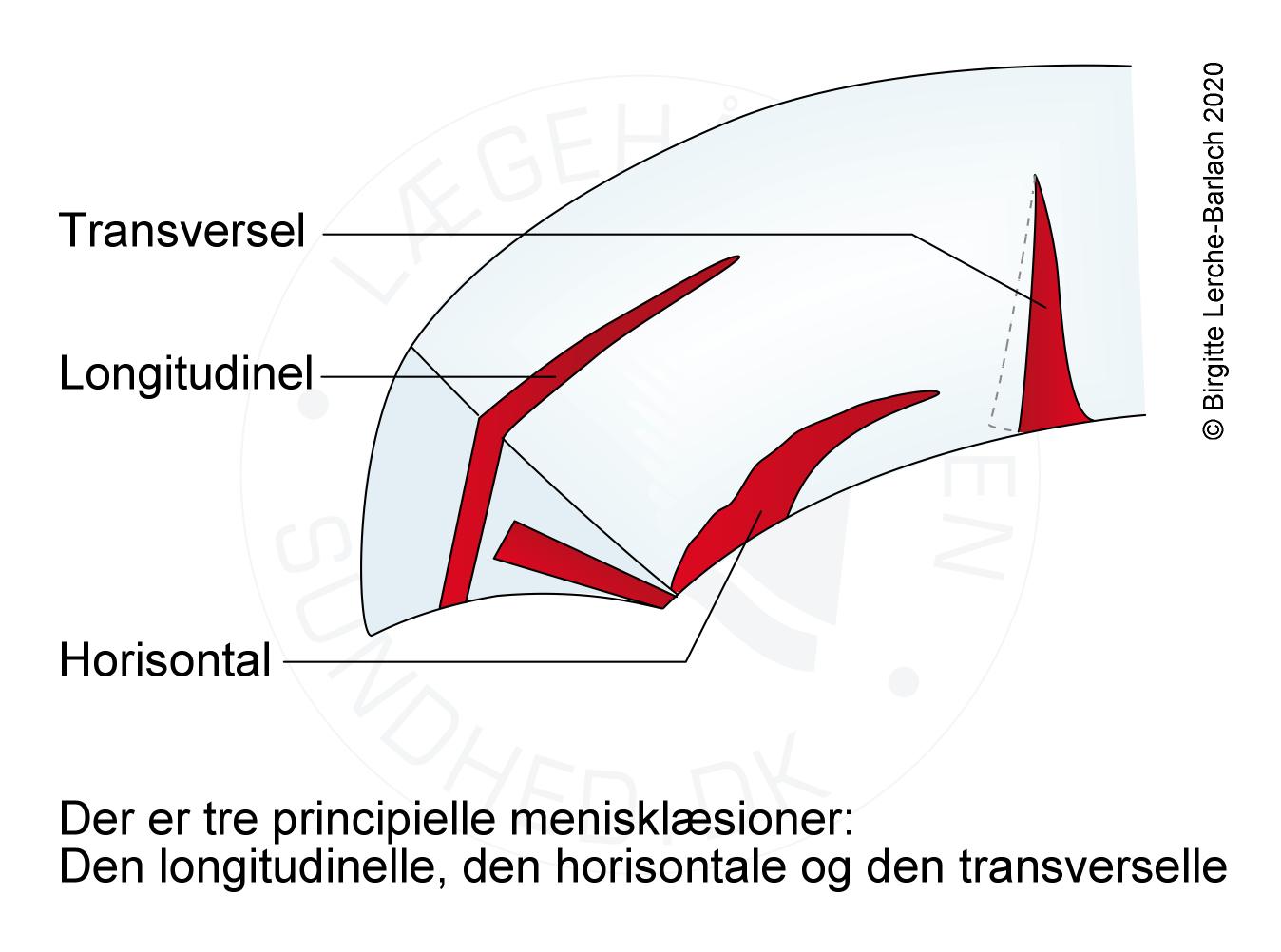 knae-menisklaesioner oversigt