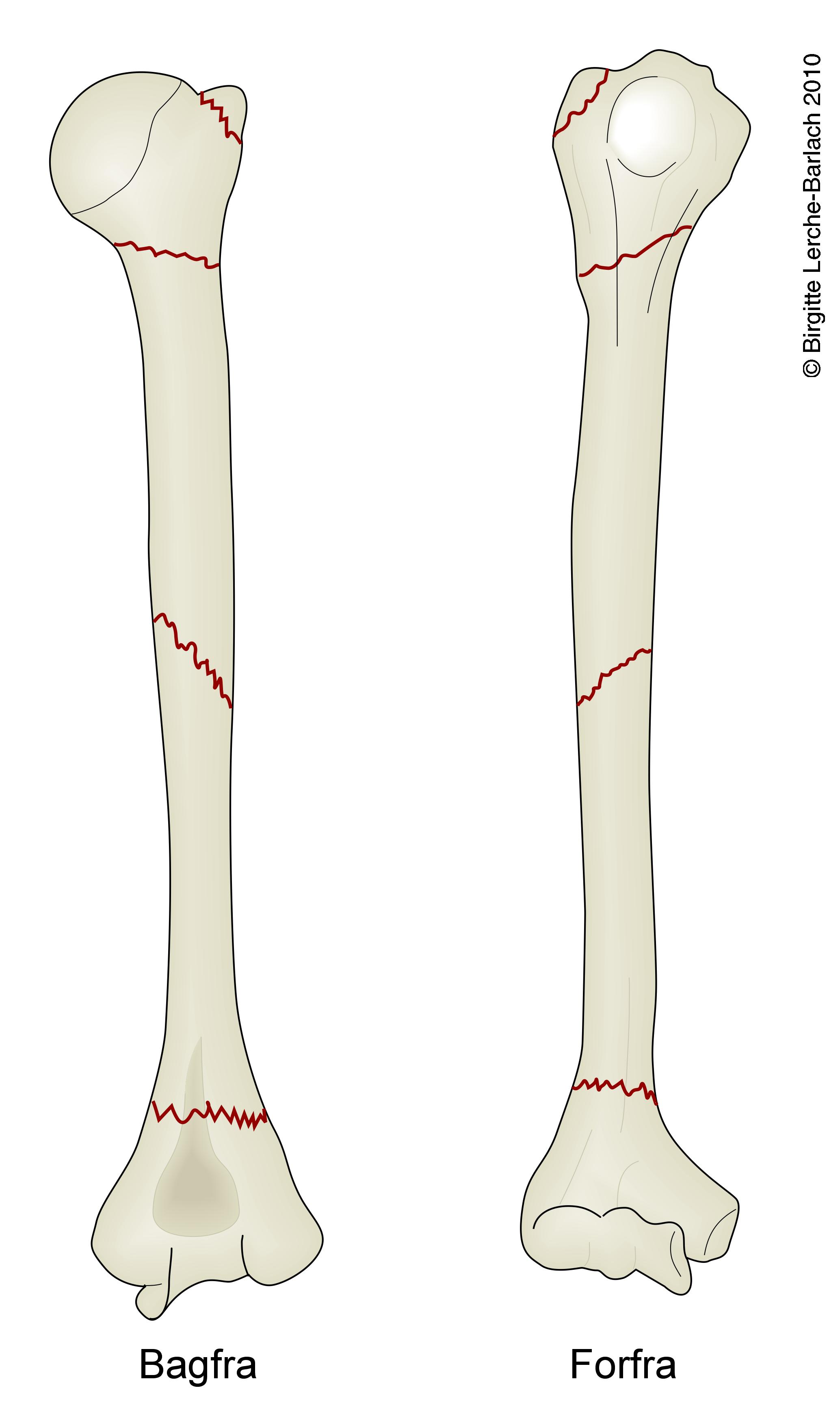 arm-humerus hyppigste brudtyper