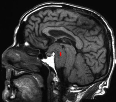 hjerne-meningeom uden kontrast-mr
