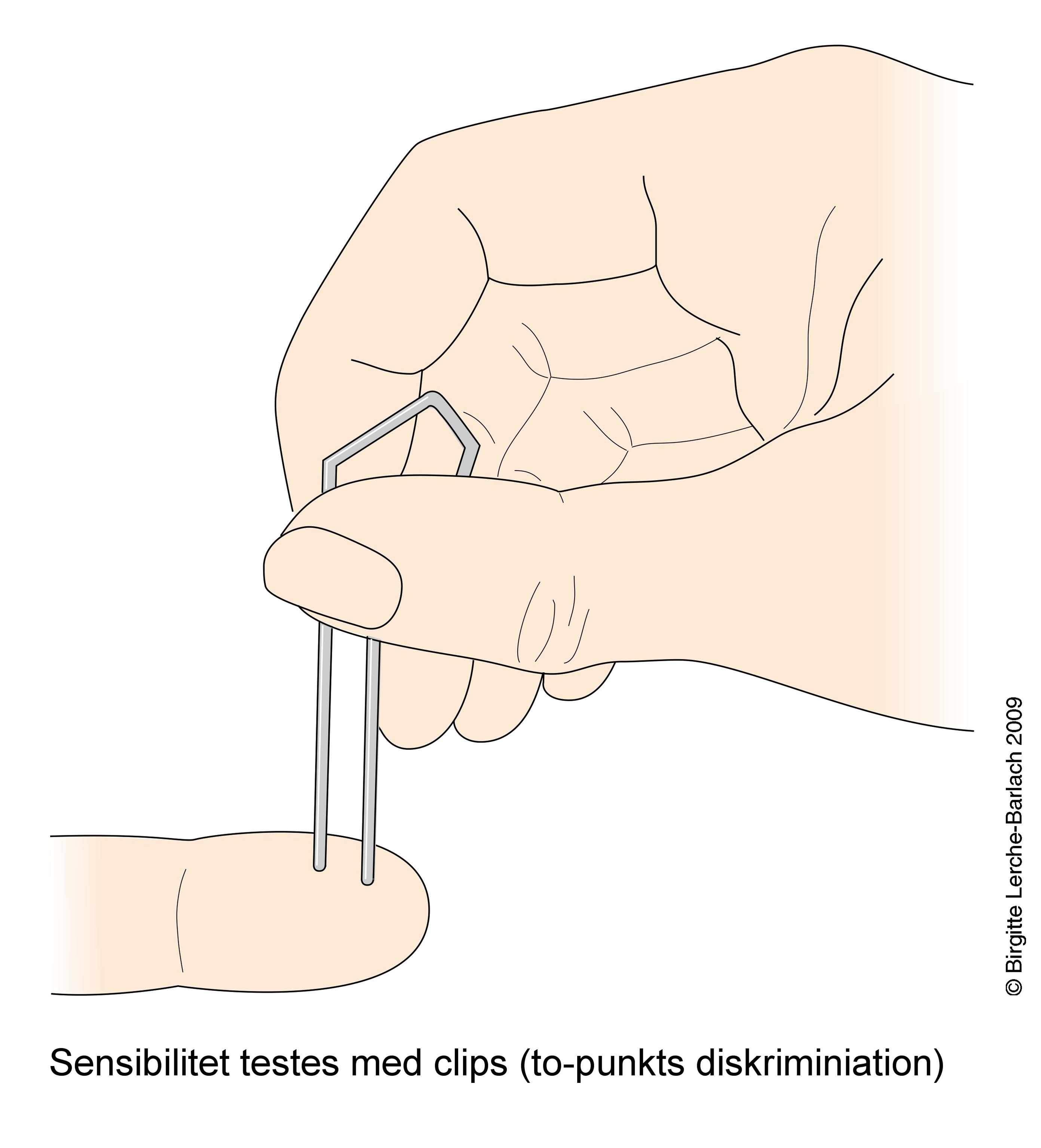 karpaltunnelsyndrom symptom 3