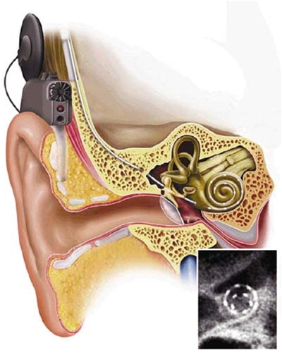 oere-cochlea implantat