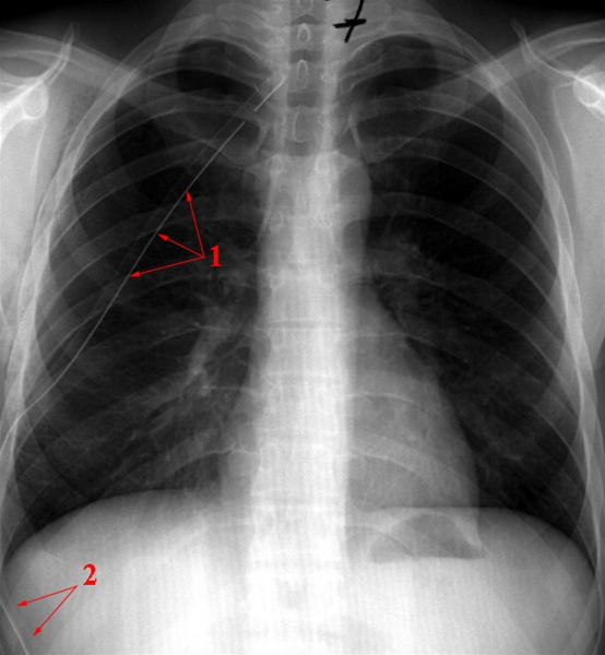 lunge-ventilpneumothorax-behandlet roentgen