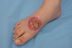 Foto af sår på fod som følge af tropesygdommen leishmaniasis