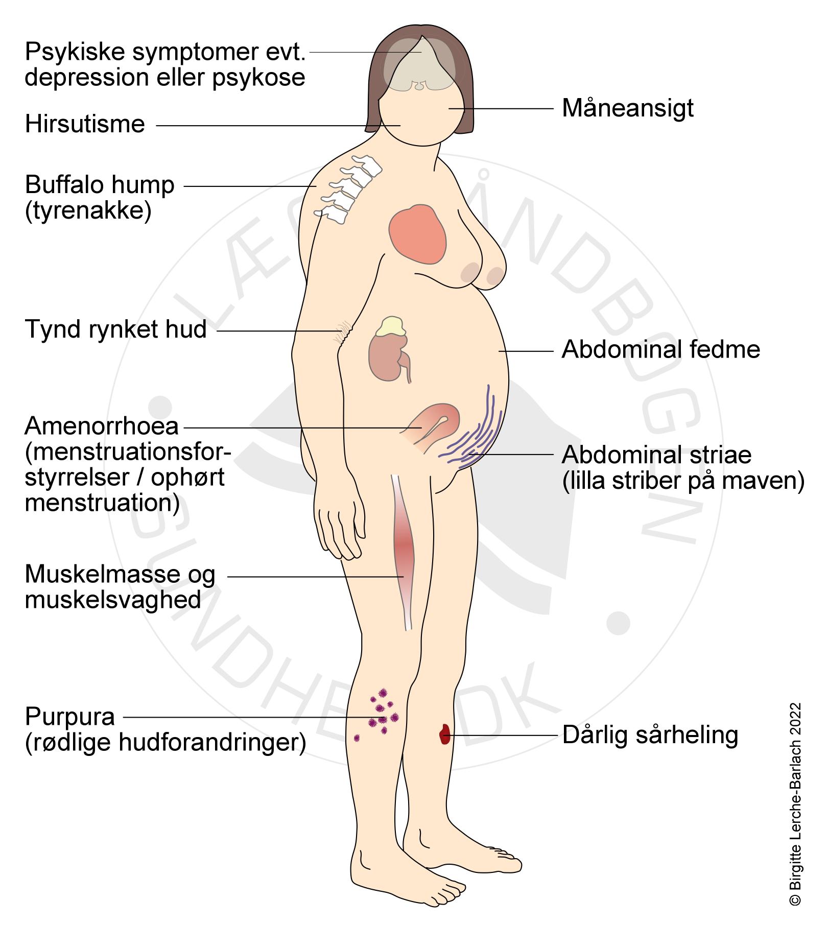 cushing patofysiologi