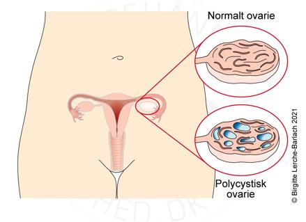 Polycystisk ovarie