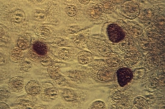 Chlamydia trachomatis.