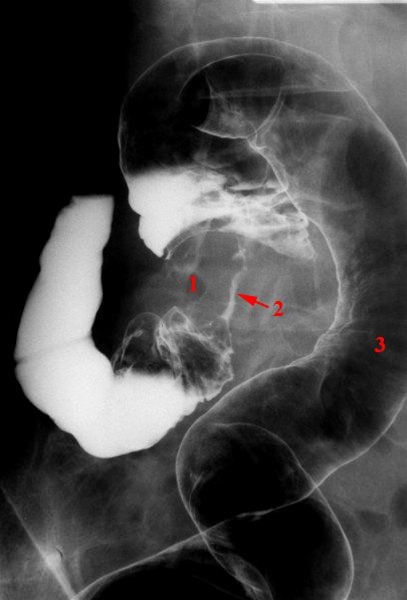 colon-cancer-roentgen