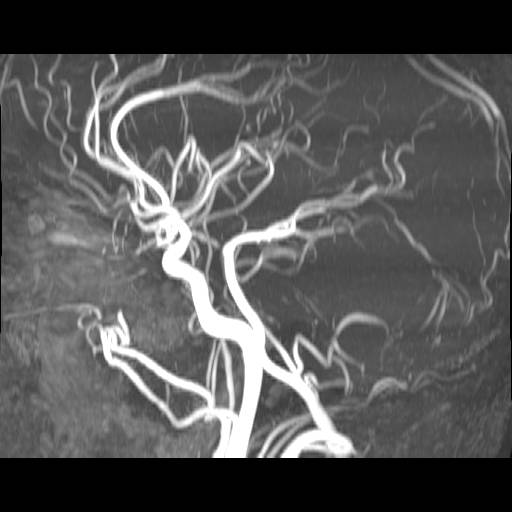 hjerne-normal karundersoegelse angiografi af hjernen 1