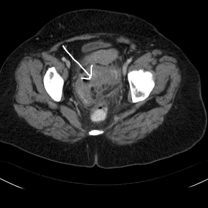 colon sigmoideum-divertkelsygdom-ct