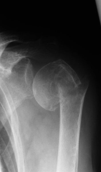 arm-humerusfraktur-roentgen