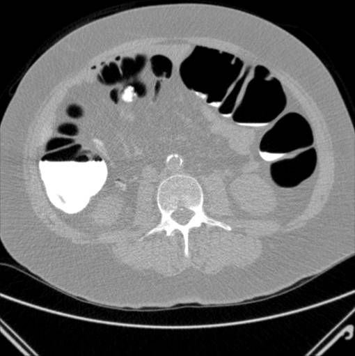 abdomen-ct