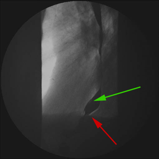 oesophagus-foede paa vej-roentgen