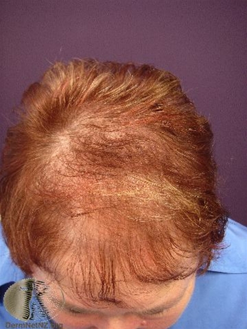 alopesi-diffus-1