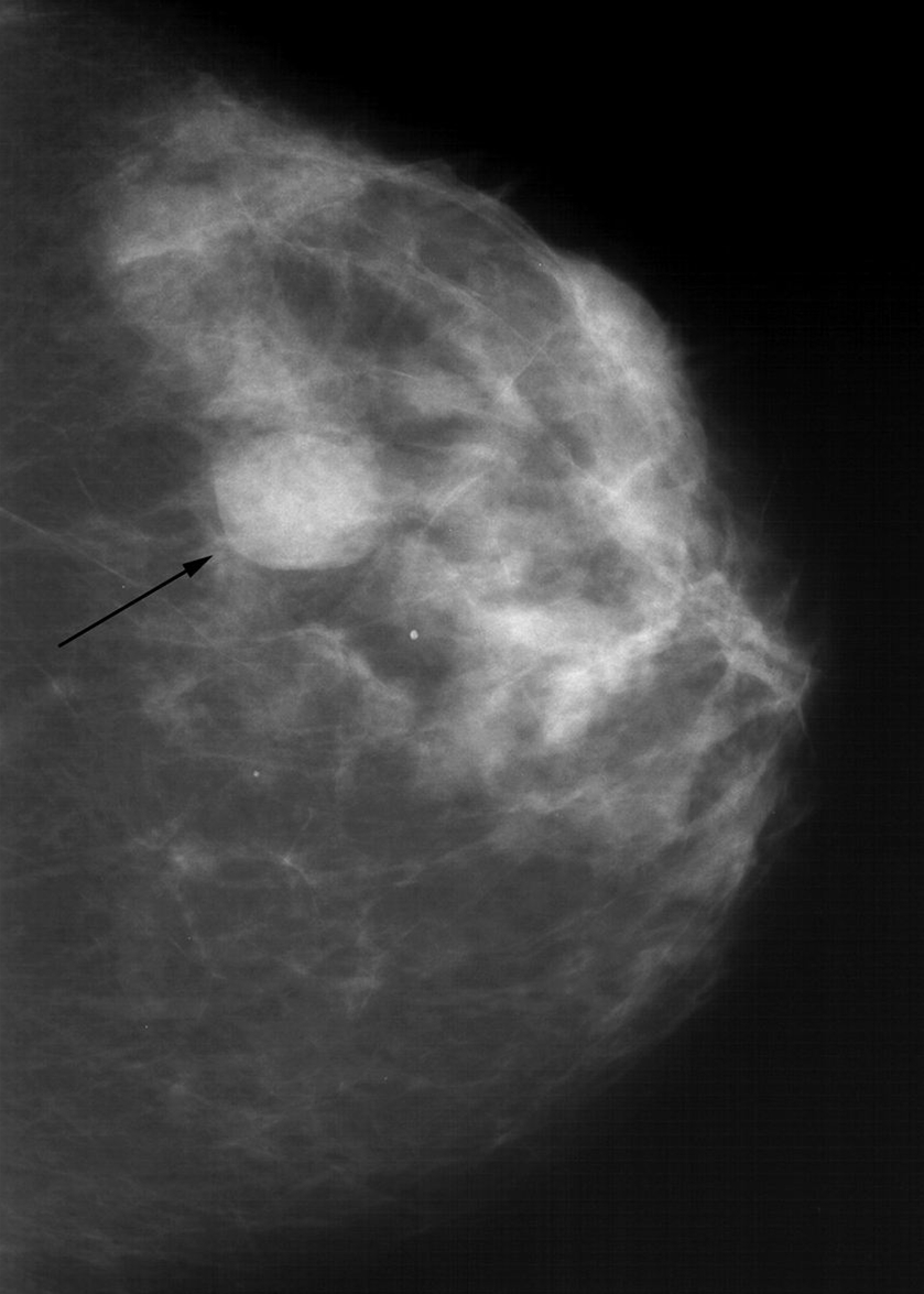 bryst-cyste-mammografi