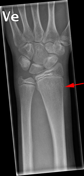 underarm-grenfraktur af den store underarmsknogle 1