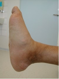 fod-kronisk charcots