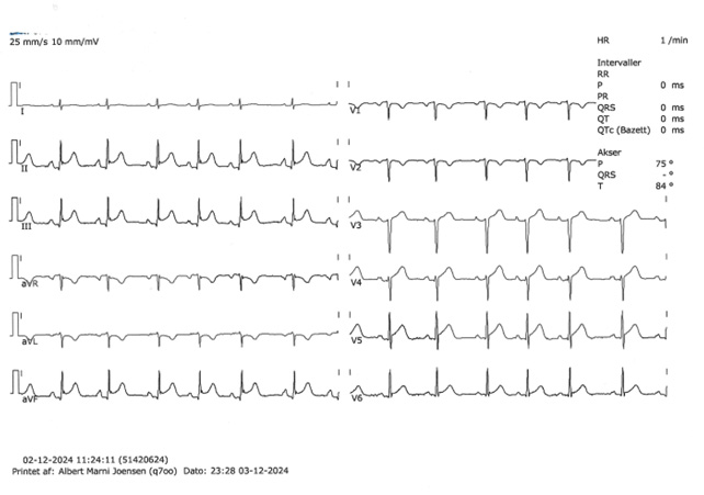 ST-segment elevation2