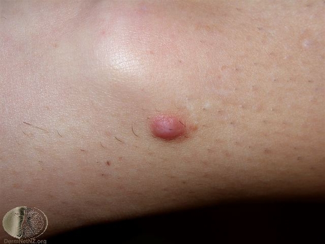 dermatofibrom rosa jpg