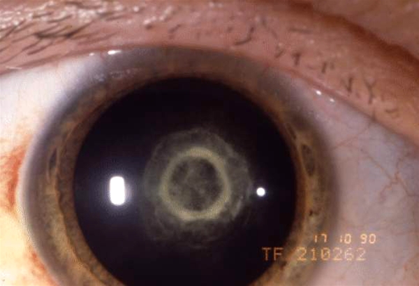 oejne-kongenitt katarakt